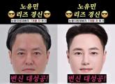 노유민, 모발이식에 이어 눈 밑 '지방 재배치'... '요즘 민증 검사도 자주 받는다'
