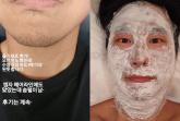 '줄기세포 시술 받았더니... M자 헤어라인에 솜털이' 후기 전한 유명 개그맨