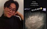 '여러분 박수 주세요!'... 박성광, 37일차 '탈모 치료' 근황 공개했다