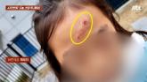 엘리베이터 천장 '구조물' 떨어져 '평생 흉터' 생긴 초등학생 아이... 업체 '고정의무 없어'